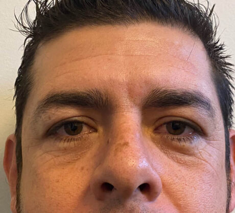 Blepharoplasty case #5327
