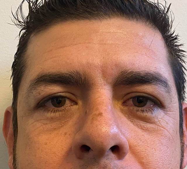 Blepharoplasty case #5327