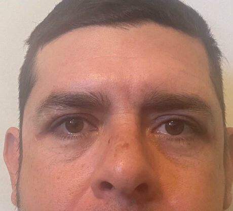 Blepharoplasty case #5327