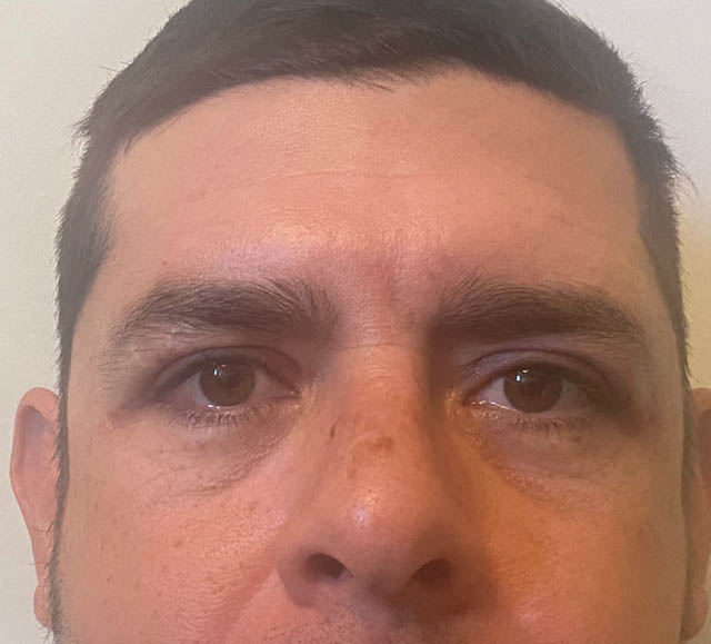 Blepharoplasty case #5327