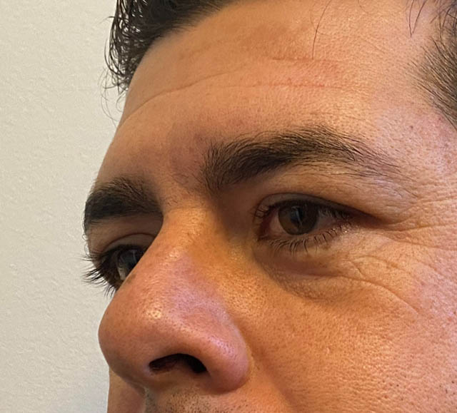 Blepharoplasty case #5327