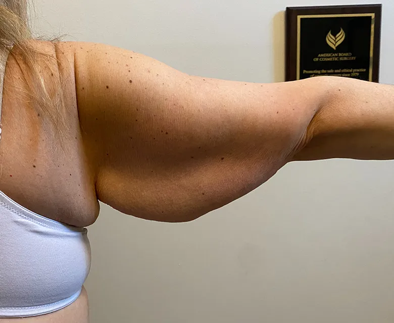 Arm Lift case #7804