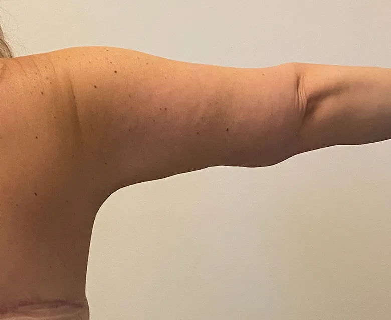 Arm Lift case #7804