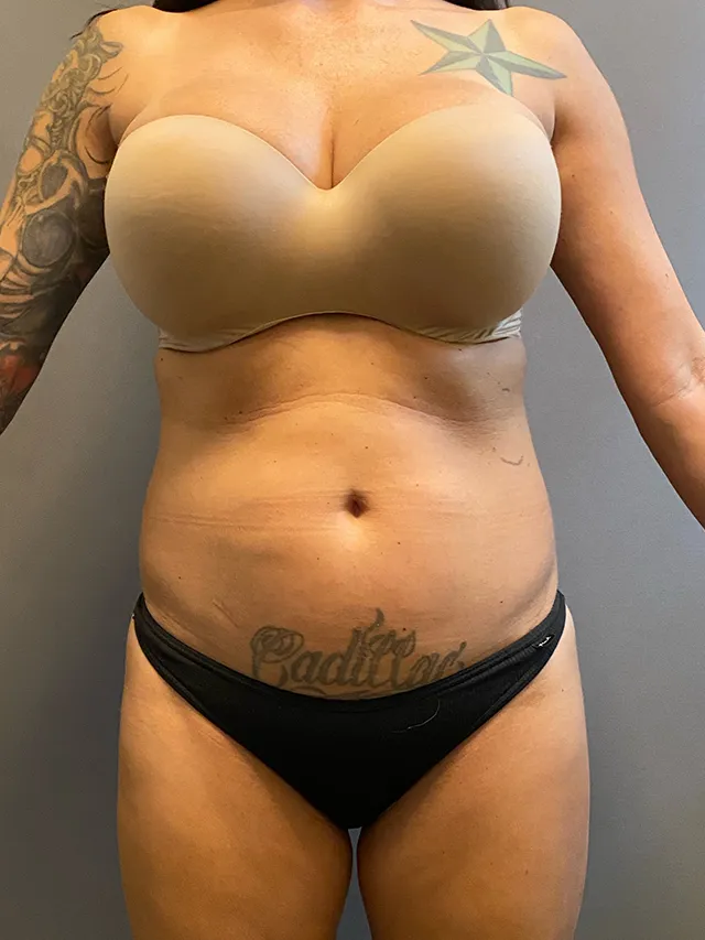 Brazilian Butt Lift case #7757