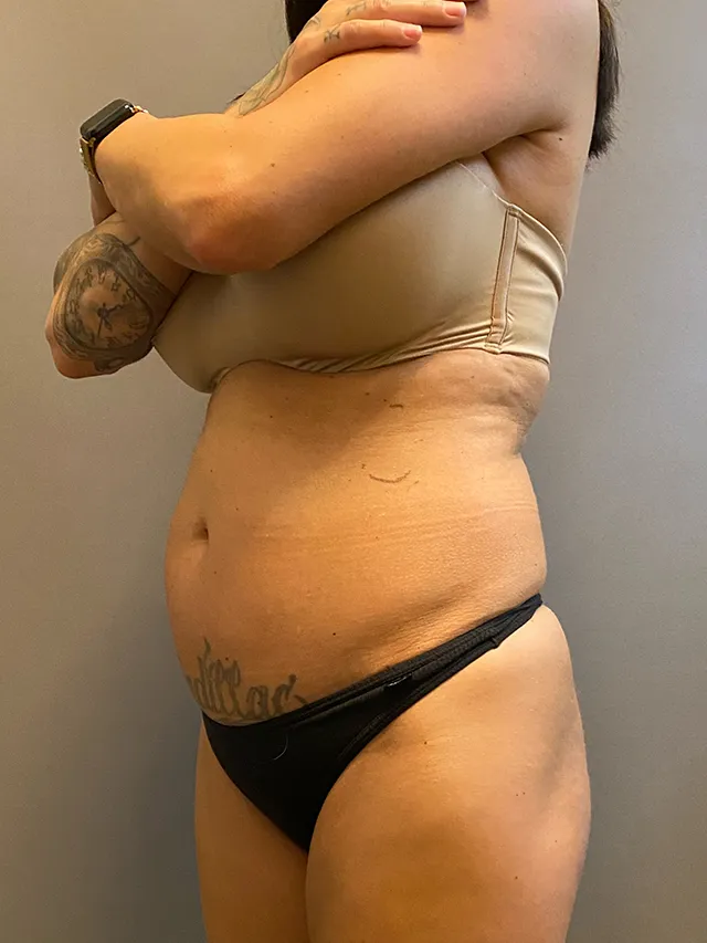 Brazilian Butt Lift case #7757