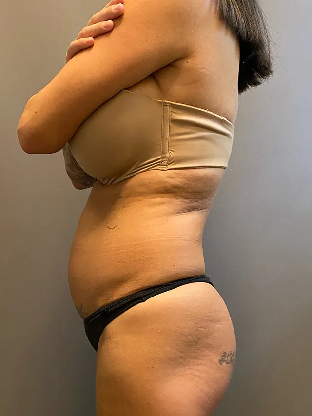 Brazilian Butt Lift case #7757