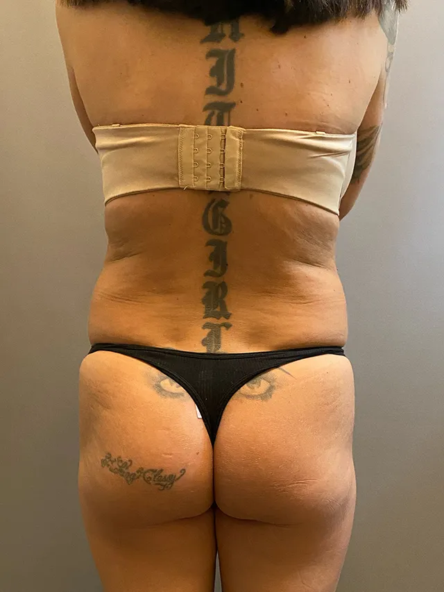 Brazilian Butt Lift case #7757