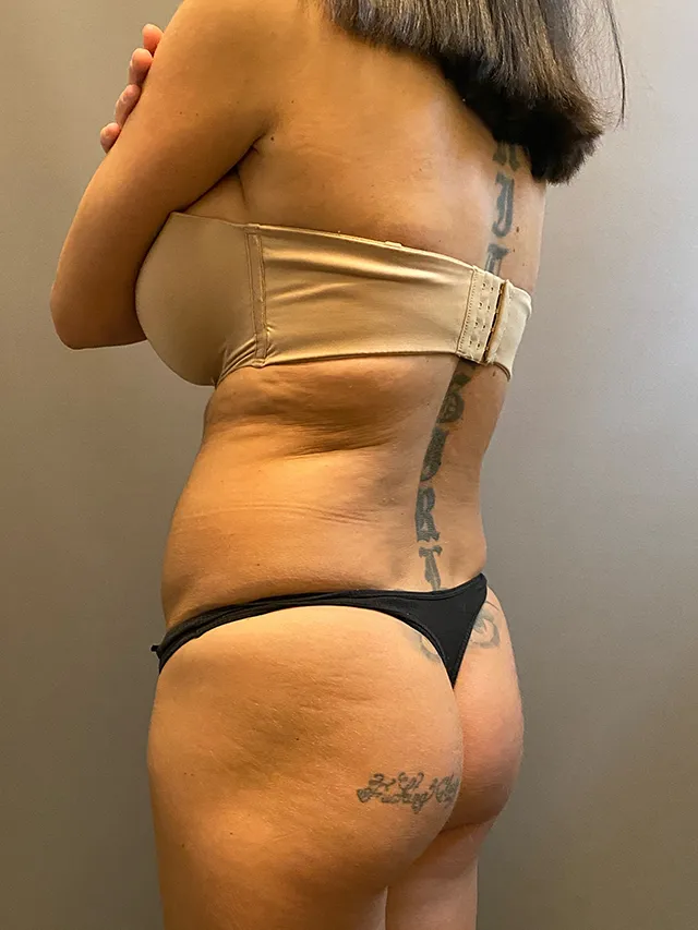 Brazilian Butt Lift case #7757