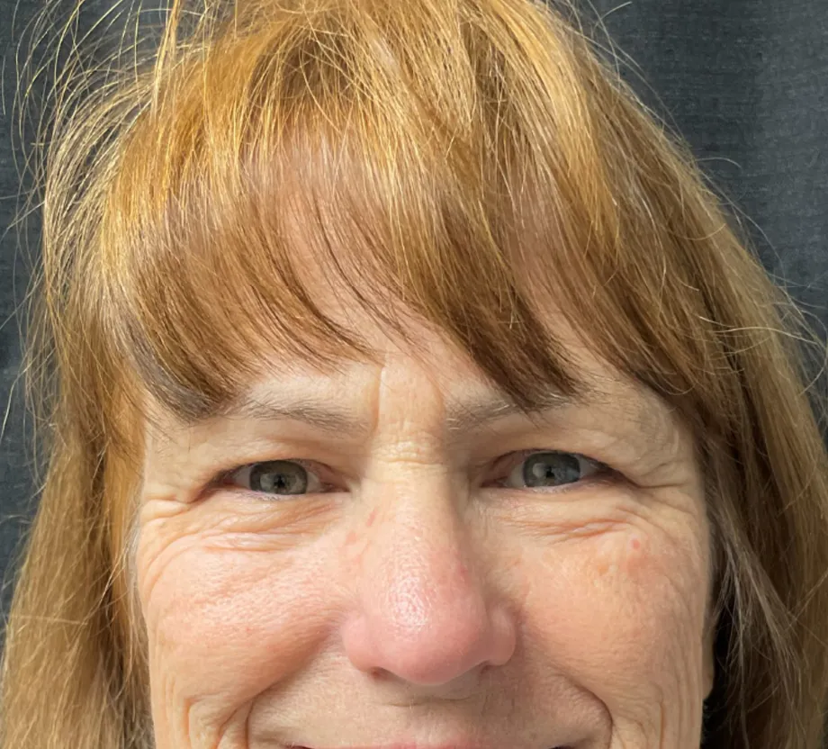 Blepharoplasty case #7786
