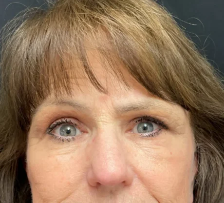 Blepharoplasty case #7786