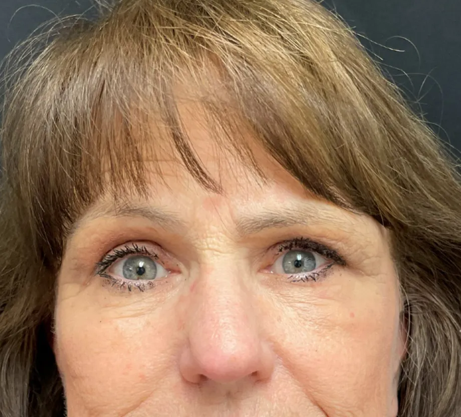 Blepharoplasty case #7786