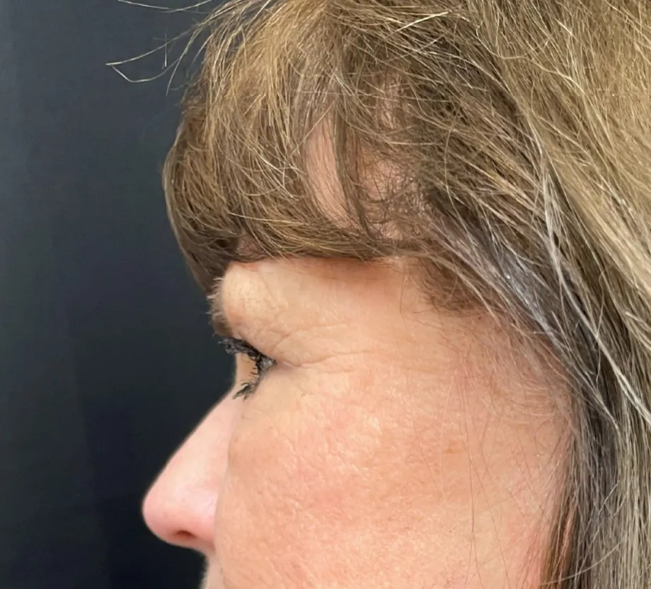 Blepharoplasty case #7786