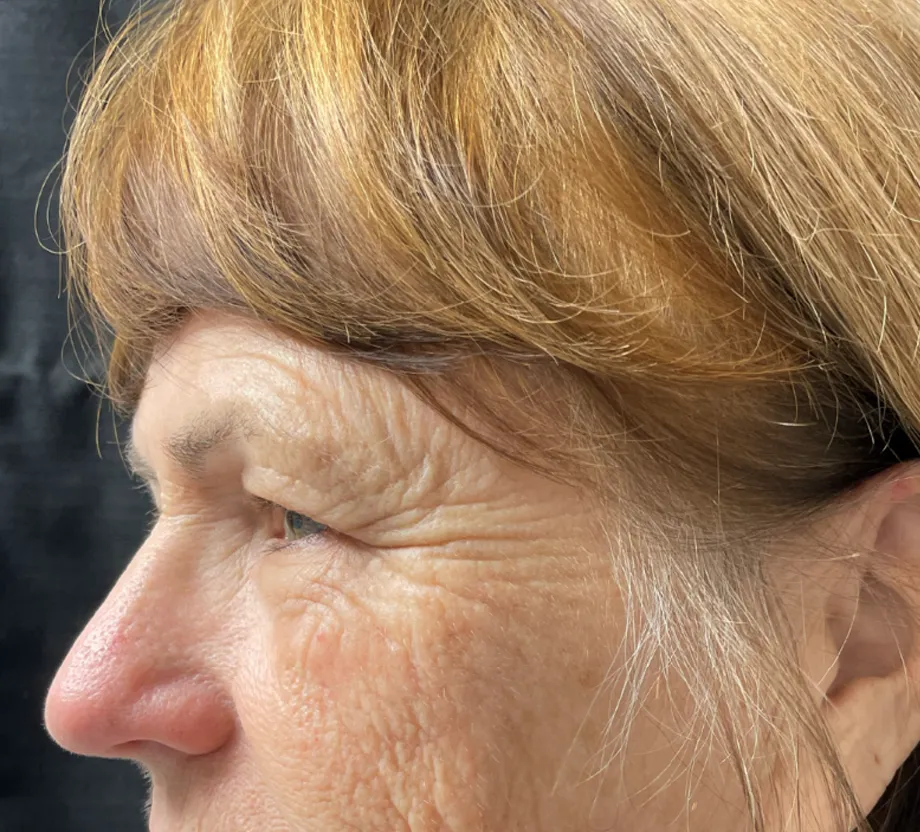 Blepharoplasty case #7786