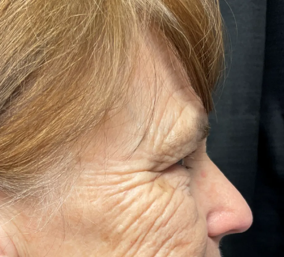 Blepharoplasty case #7786