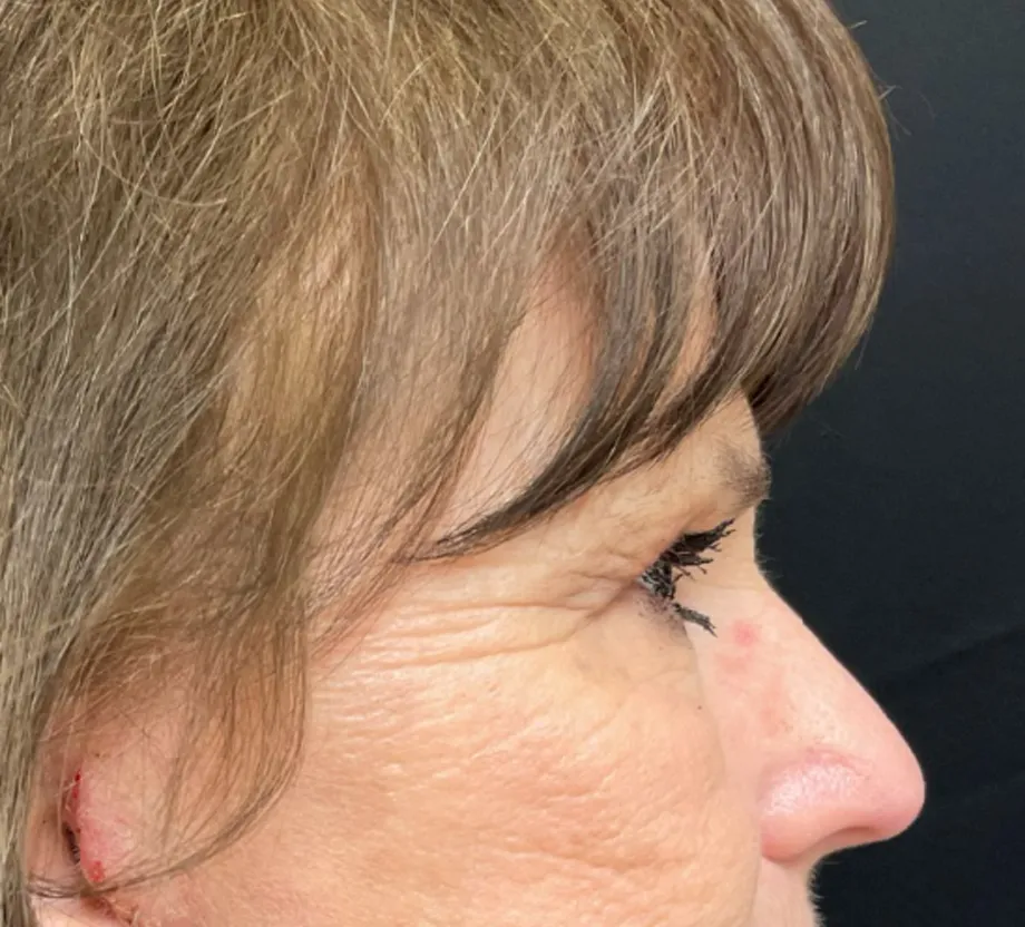 Blepharoplasty case #7786