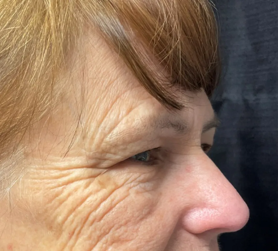 Blepharoplasty case #7786