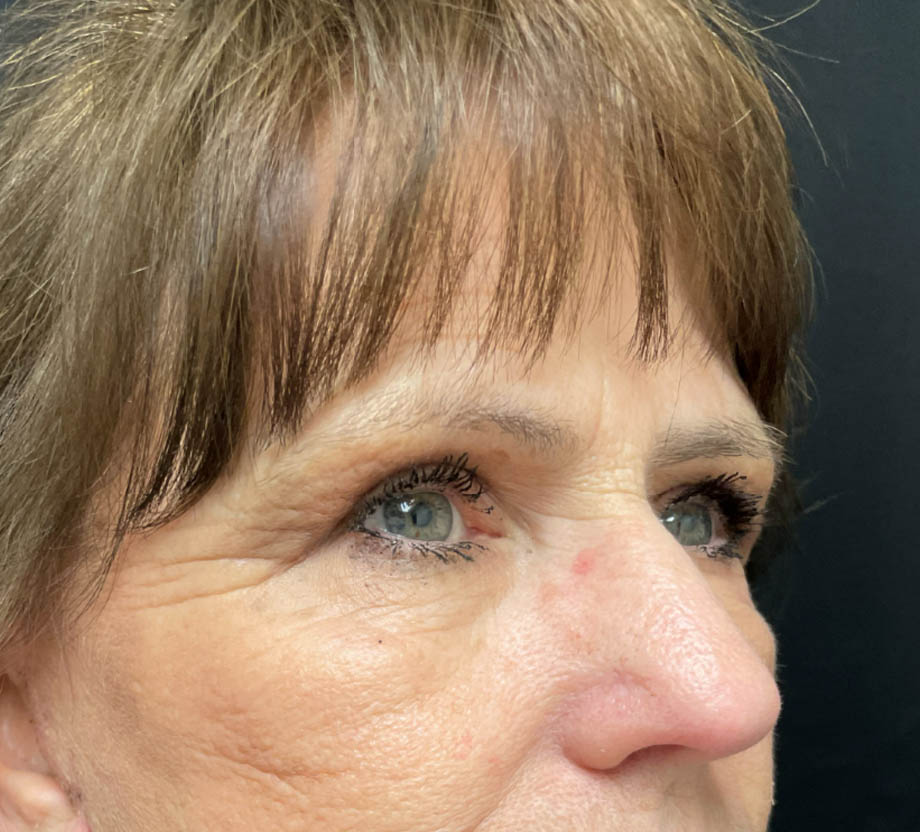 Blepharoplasty case #7786