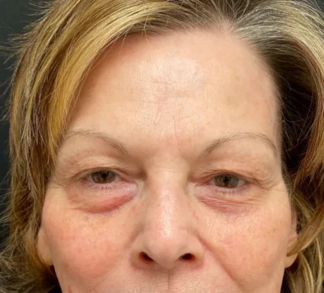 Blepharoplasty case #7797