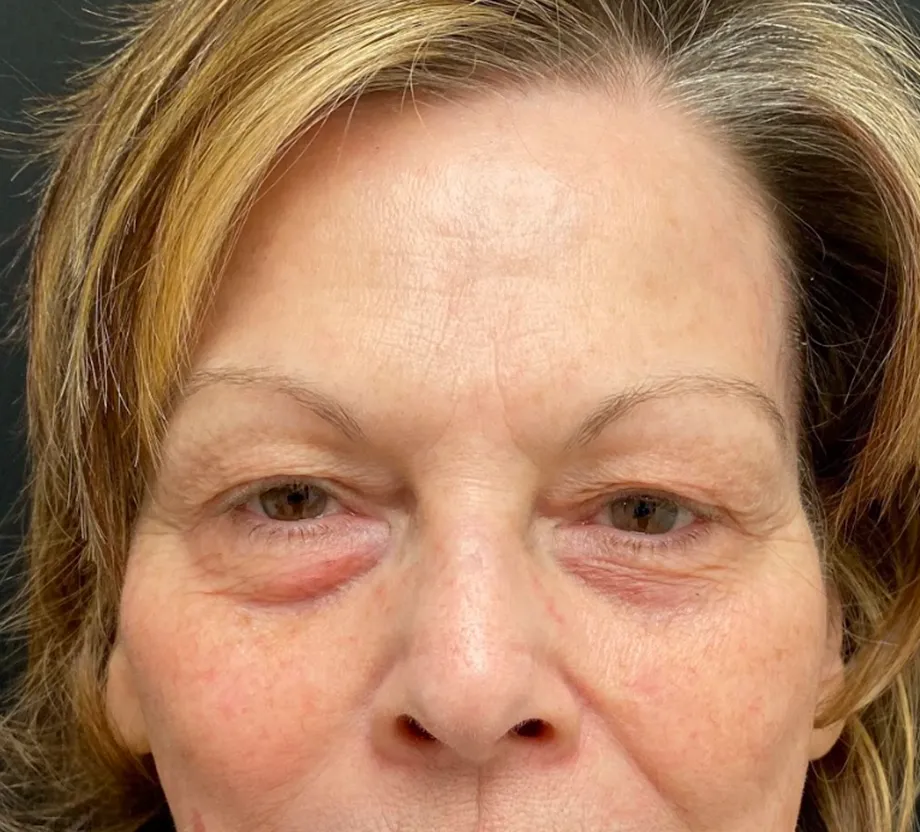 Blepharoplasty case #7797