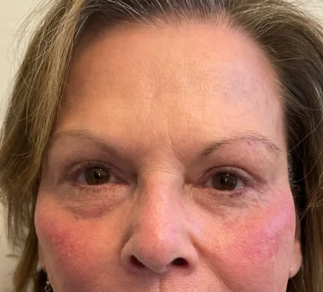 Blepharoplasty case #7797
