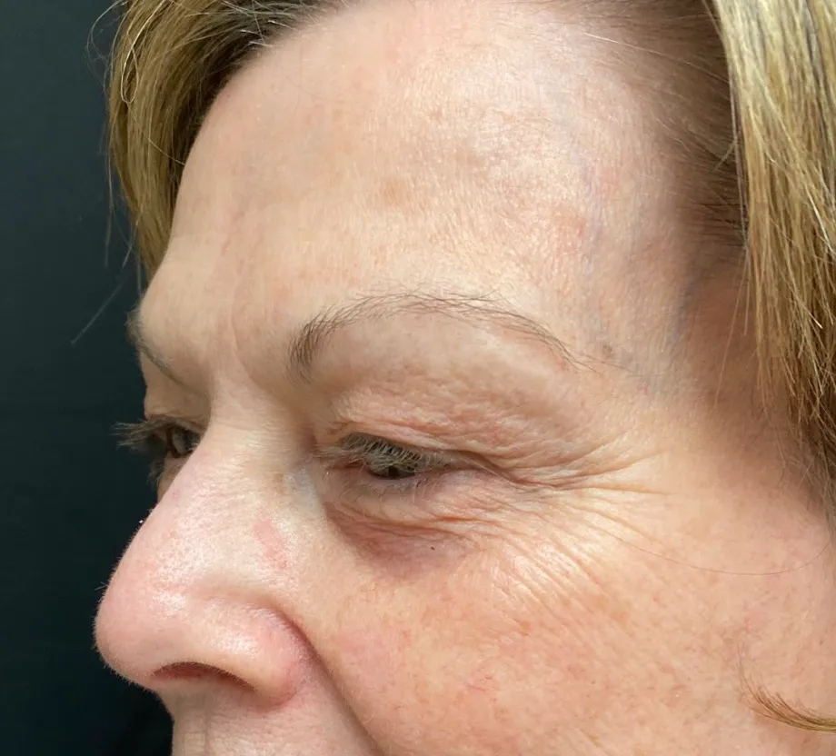 Blepharoplasty case #7797