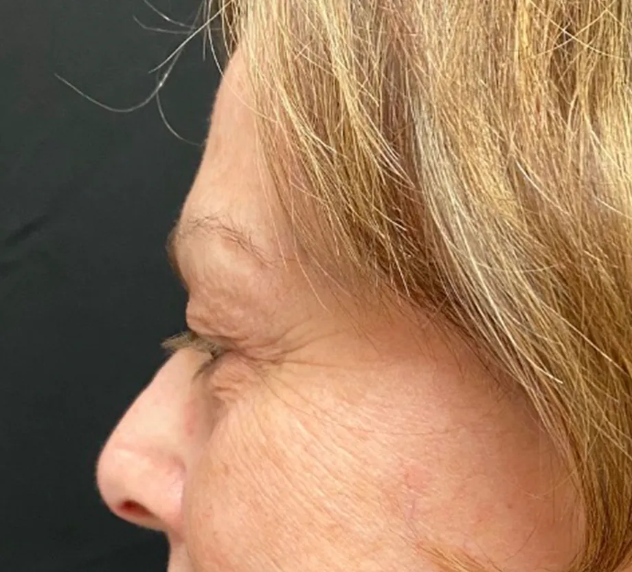 Blepharoplasty case #7797
