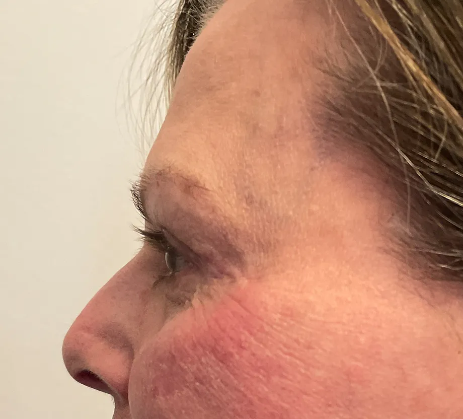 Blepharoplasty case #7797