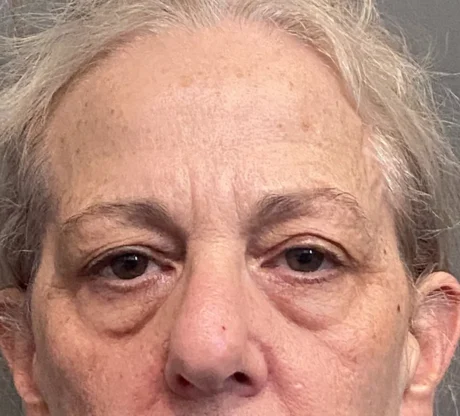 Blepharoplasty case #7775