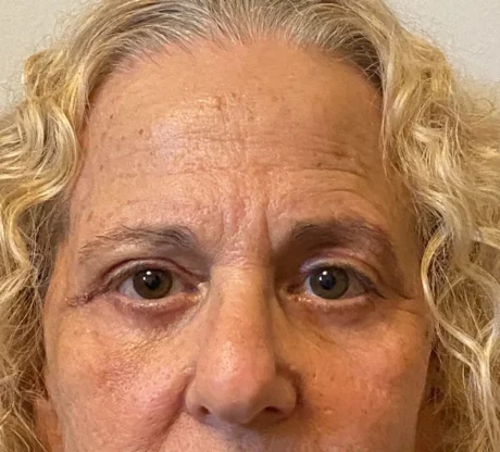 Blepharoplasty case #7775