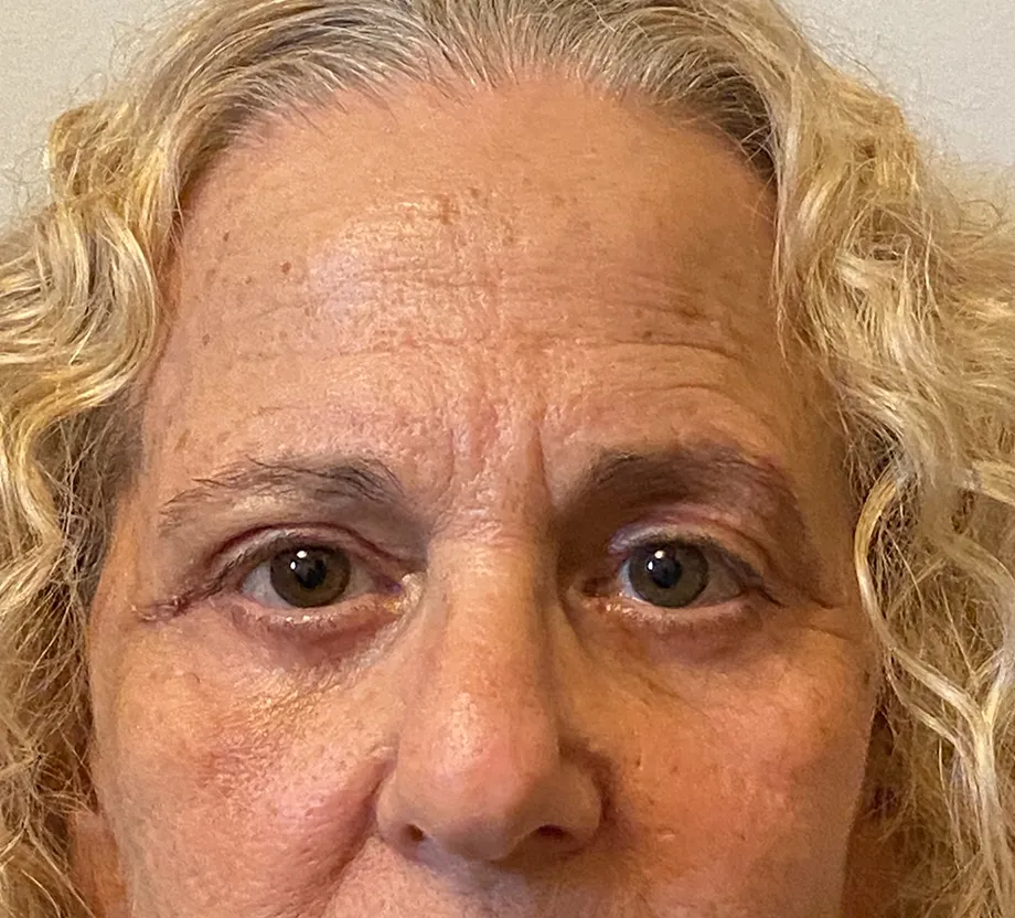 Blepharoplasty case #7775