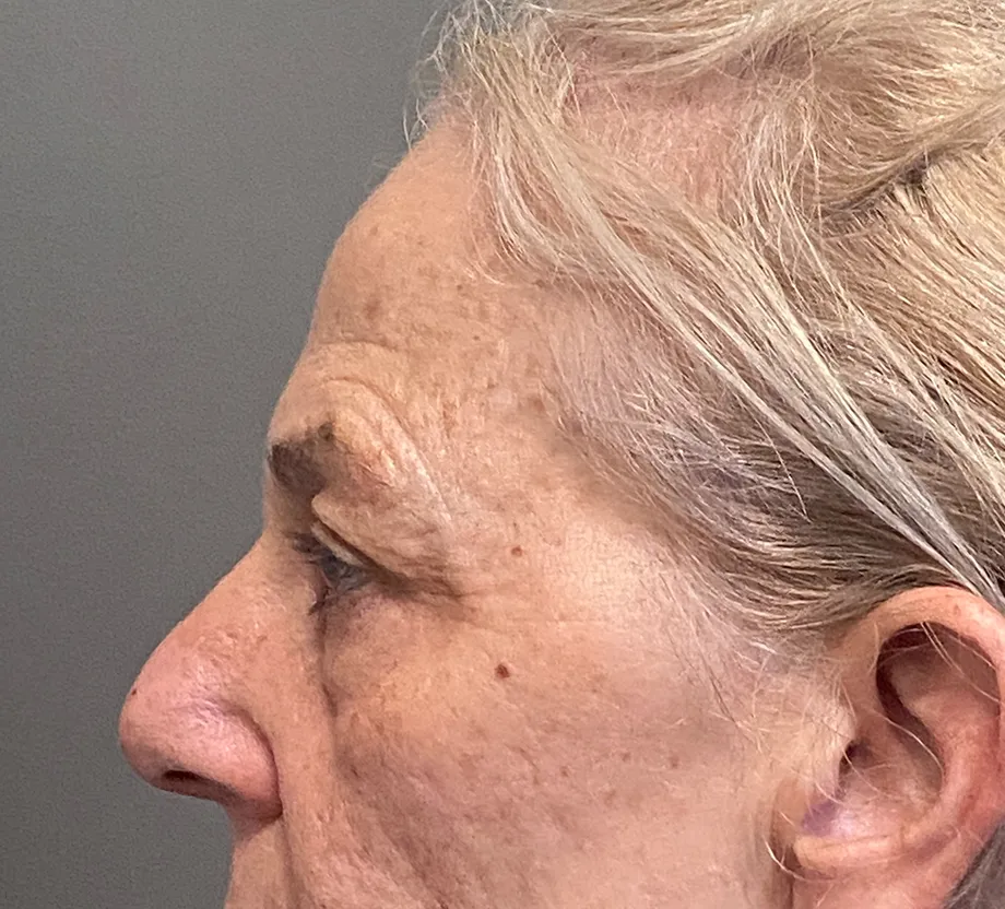 Blepharoplasty case #7775