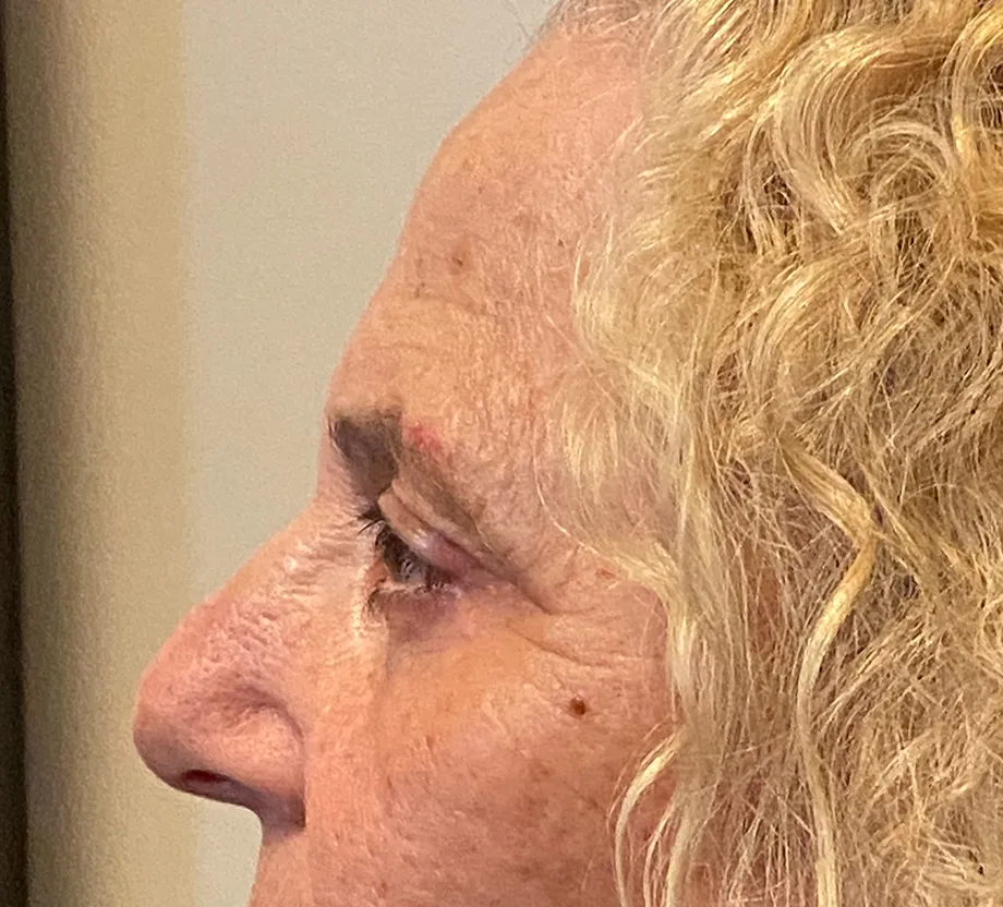 Blepharoplasty case #7775