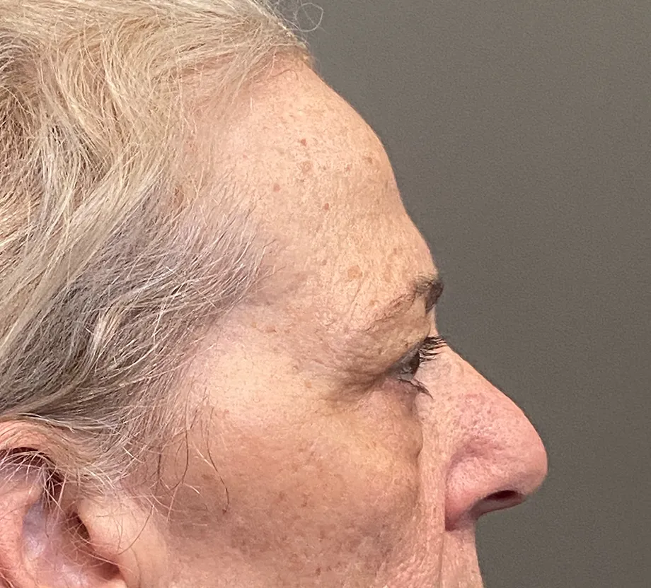Blepharoplasty case #7775