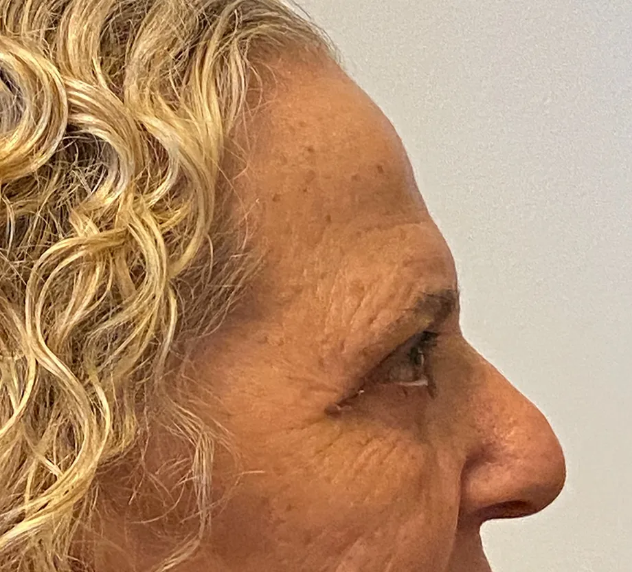 Blepharoplasty case #7775