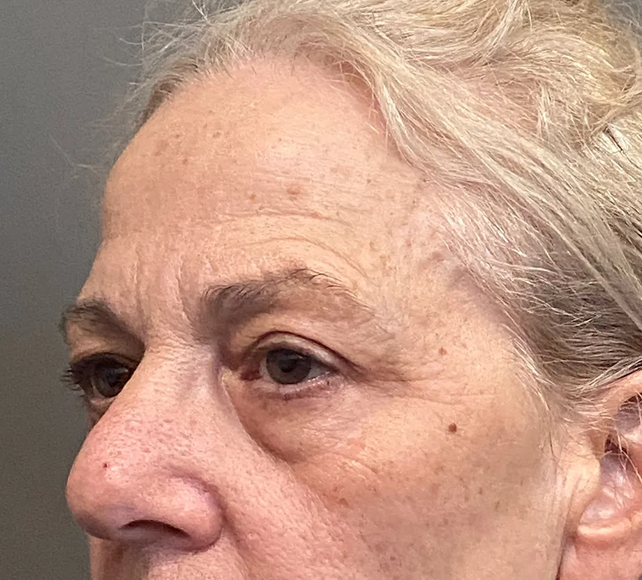Blepharoplasty case #7775