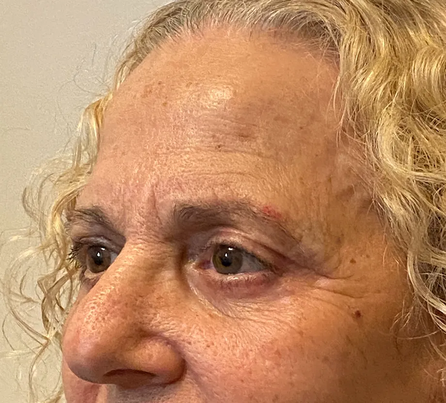 Blepharoplasty case #7775