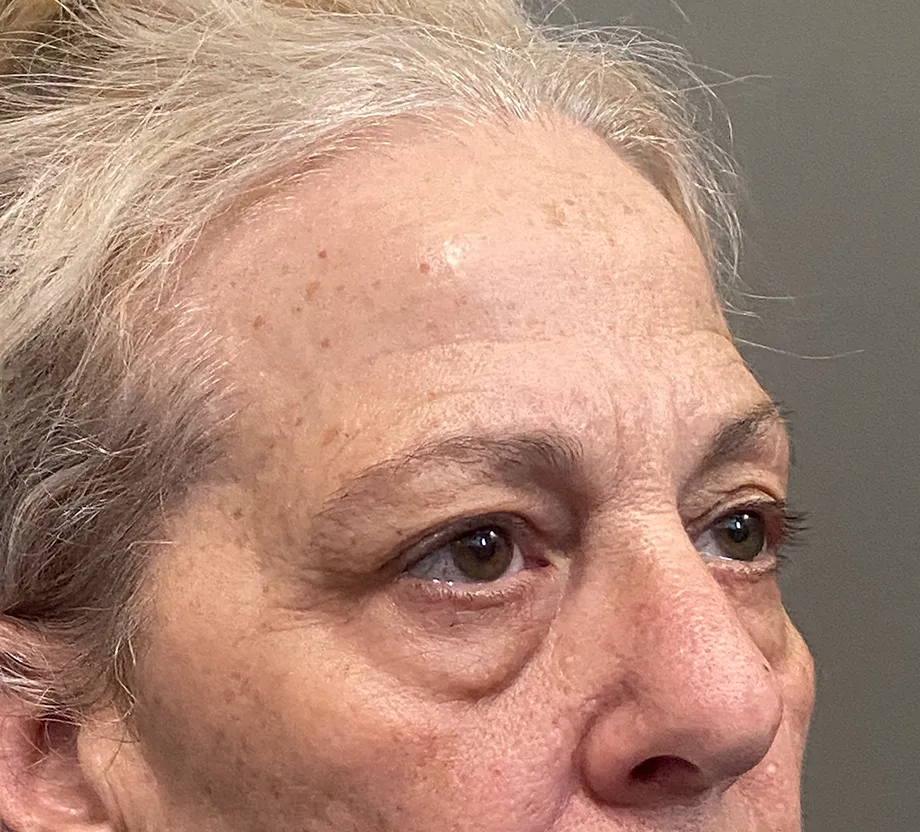 Blepharoplasty case #7775