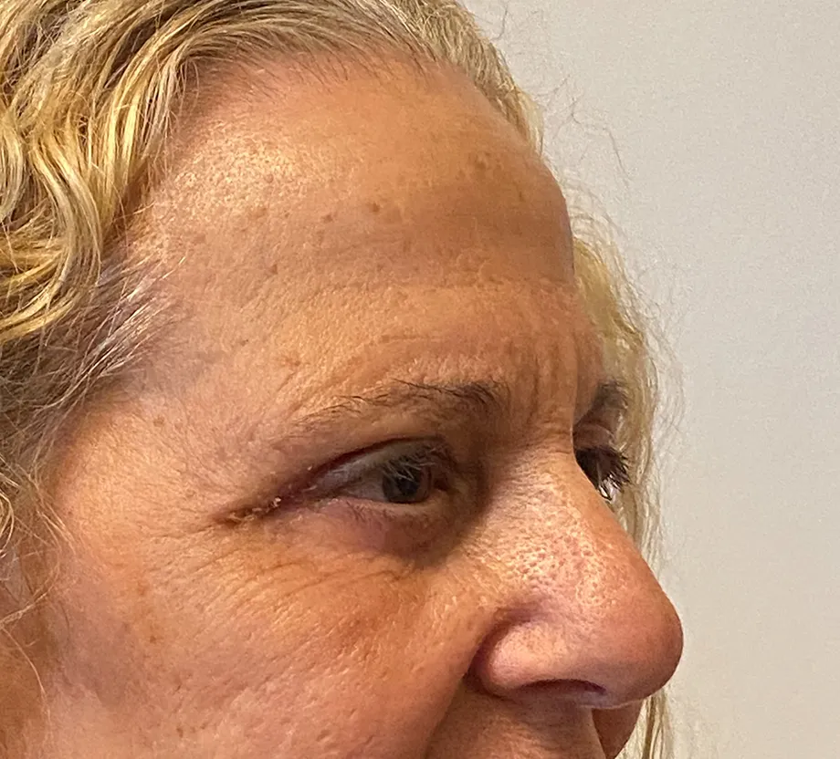Blepharoplasty case #7775