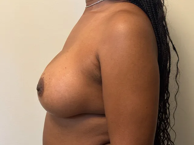 Breast Augmentation case #7819