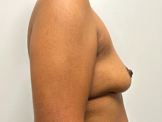 Breast Augmentation case #7819
