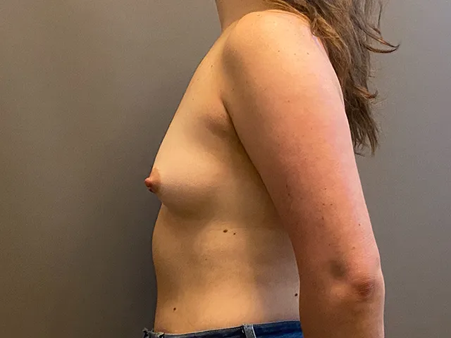 Breast Augmentation case #7838