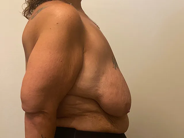 Breast Lift case #7858