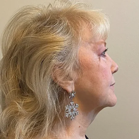 Facelift case #7871
