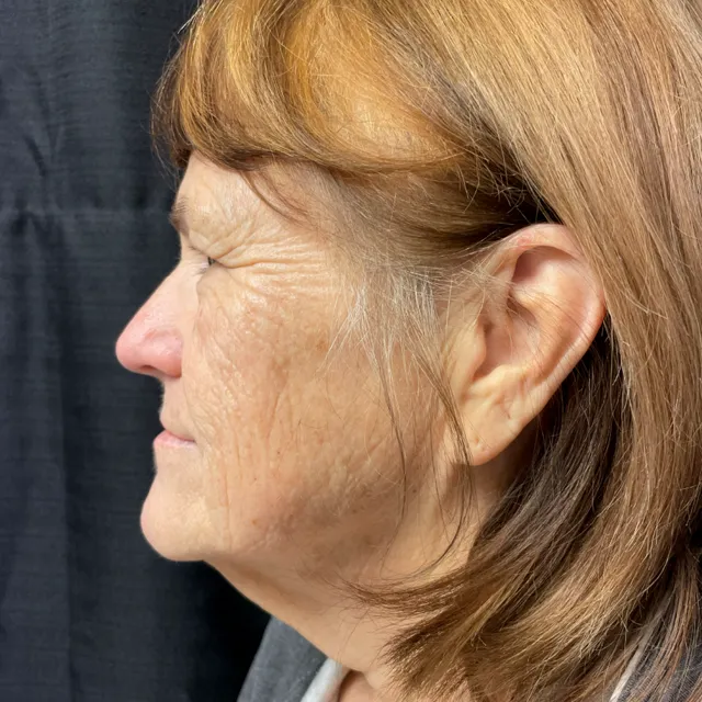 Facelift case #7889