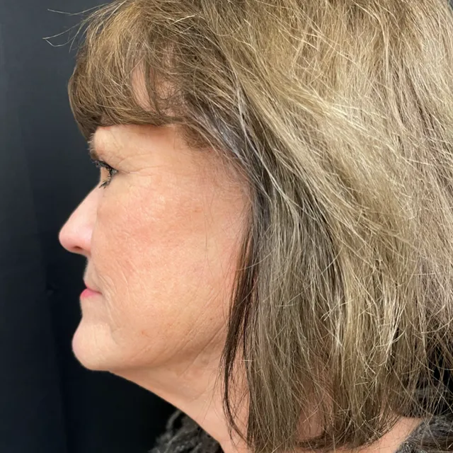 Facelift case #7889