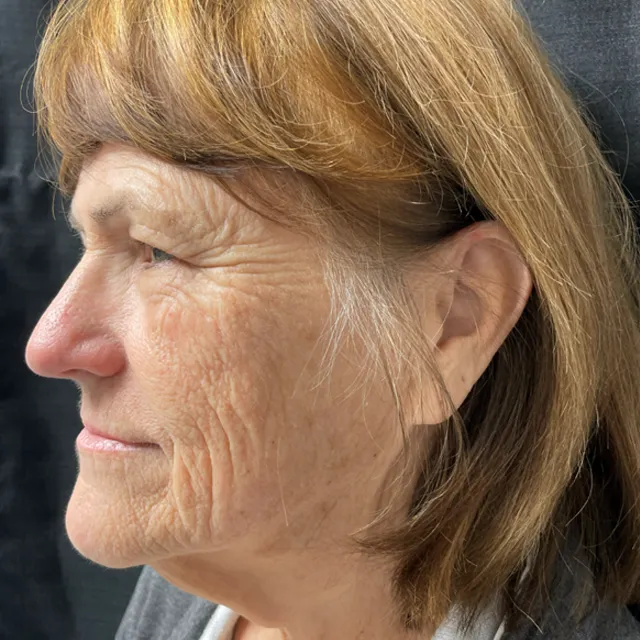 Facelift case #7889