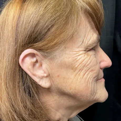 Facelift case #7889