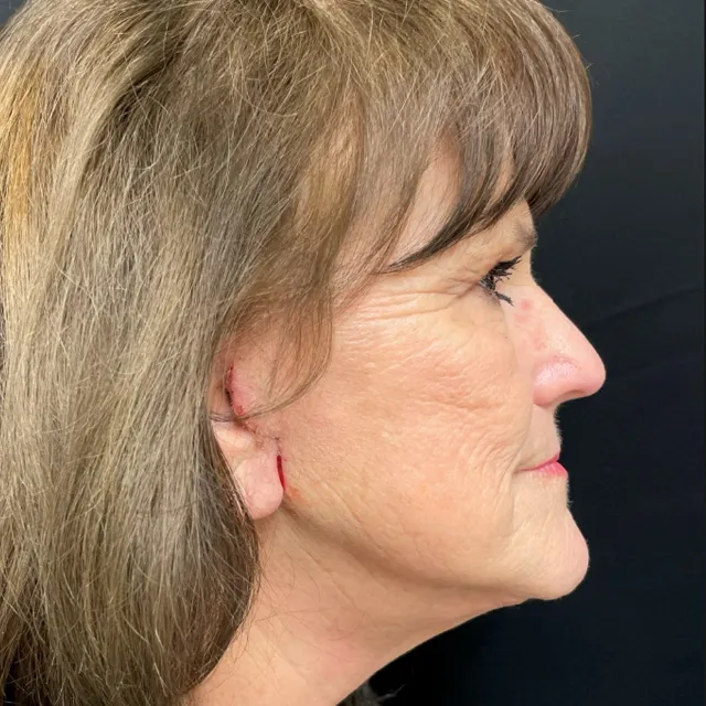 Facelift case #7889