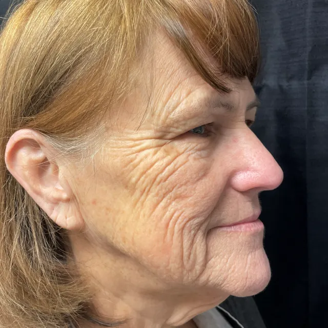 Facelift case #7889