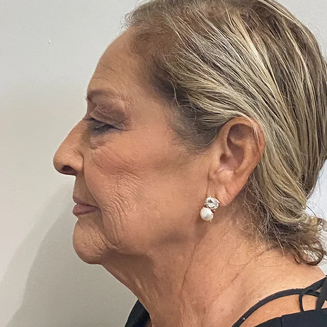 Facelift case #7900